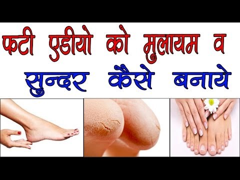 फटी एड़ियो को मुलायम व सुन्दर कैसे बनाये ॥ Home Remedies For Cracked Heels ॥ Health Care