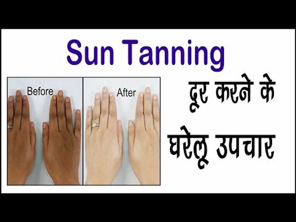 Sun Tanning दूर करने के घरेलू उपचार || How To Remove Sun Tan Instantly || Arogya India