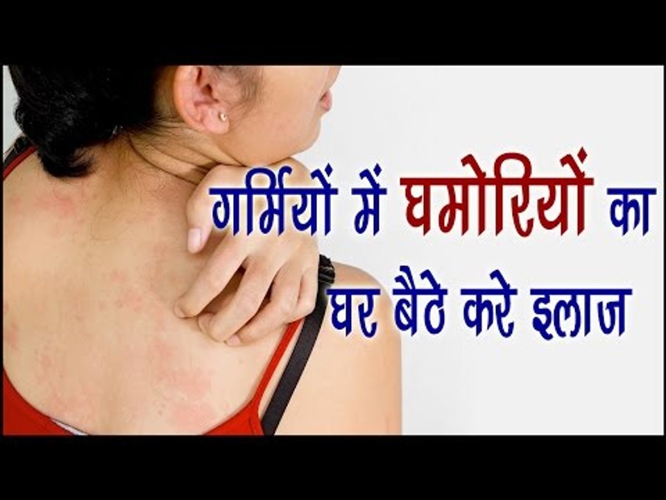 गर्मियों में घमोरियों का घर बैठे करे इलाज || Effective Home Remedies For Prickly Heat