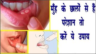 मुँह के छालों से है परेशान तो करें ये उपाय || Remedy To Treat Mouth Ulcer || Arogya India