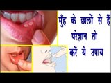 मुँह के छालों से है परेशान तो करें ये उपाय || Remedy To Treat Mouth Ulcer || Arogya India