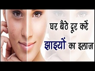 घर बैठे दूर करें झाइयों का इलाज || Treatment Of Pigmentation At Home || Health Tips By Shristi