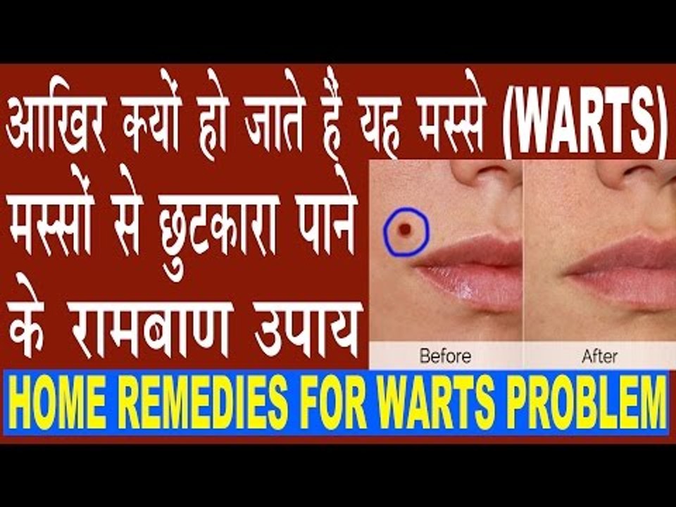 मस्सों को हटाने के रामबाण उपाय | Warts Removal Home Remedies | Masso Ka Gharelu Ilaj