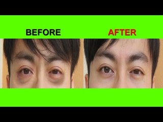 How to Remove Dark Circles|डार्क सर्कल्स को अलविदा कहें|aankhon ke kala ghera dur karnay ke upaya