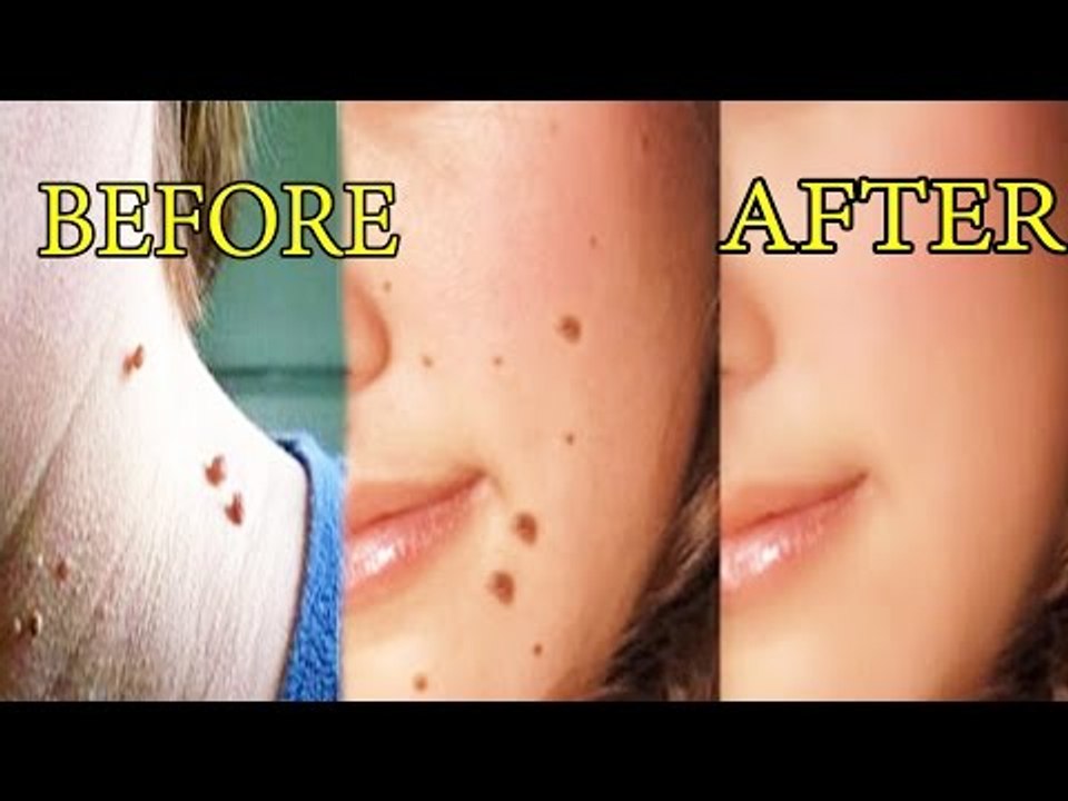 मस्सों और अनचाहे तिलों को हटाने के रामबाण उपाय । Reamove Warts And Moles Fast At Home