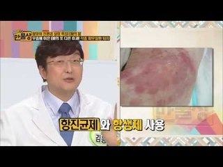 무좀에 이은 EM의 또 다른 효과! 각종 피부질환 퇴치 [만물상 54회]