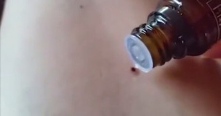 Genç Kadın Vücuduna Yapışan Keneyi Nane Yağıyla Söktü Attı