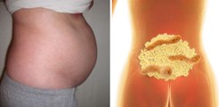 This is why you have bloated stomach and how to get rid of bloating and lose weight overnight