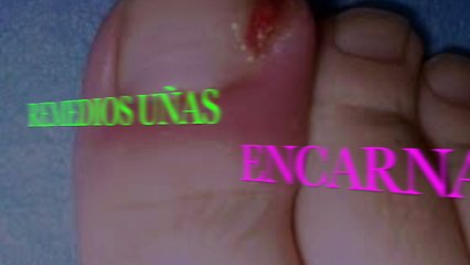 Es muy fácil de tratar una uña encarnada en casa! Sólo tienes que hacer esto!