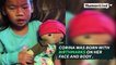 Little girl with birthmarks is given a special gift to boost her confidence-jbqtdwni38k