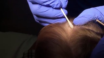 Voilà comment on retire une tique du crane d'un homme