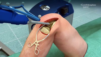 NAVIO Surgical System Animated