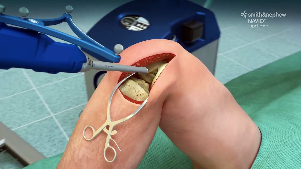 NAVIO Surgical System Animated