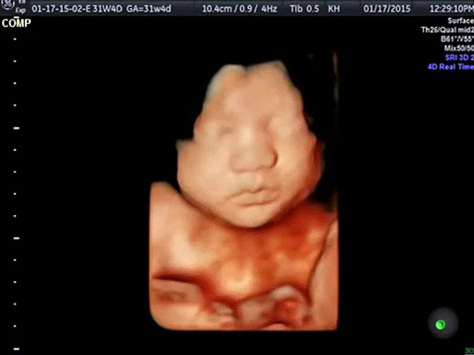 3D Ultrasound