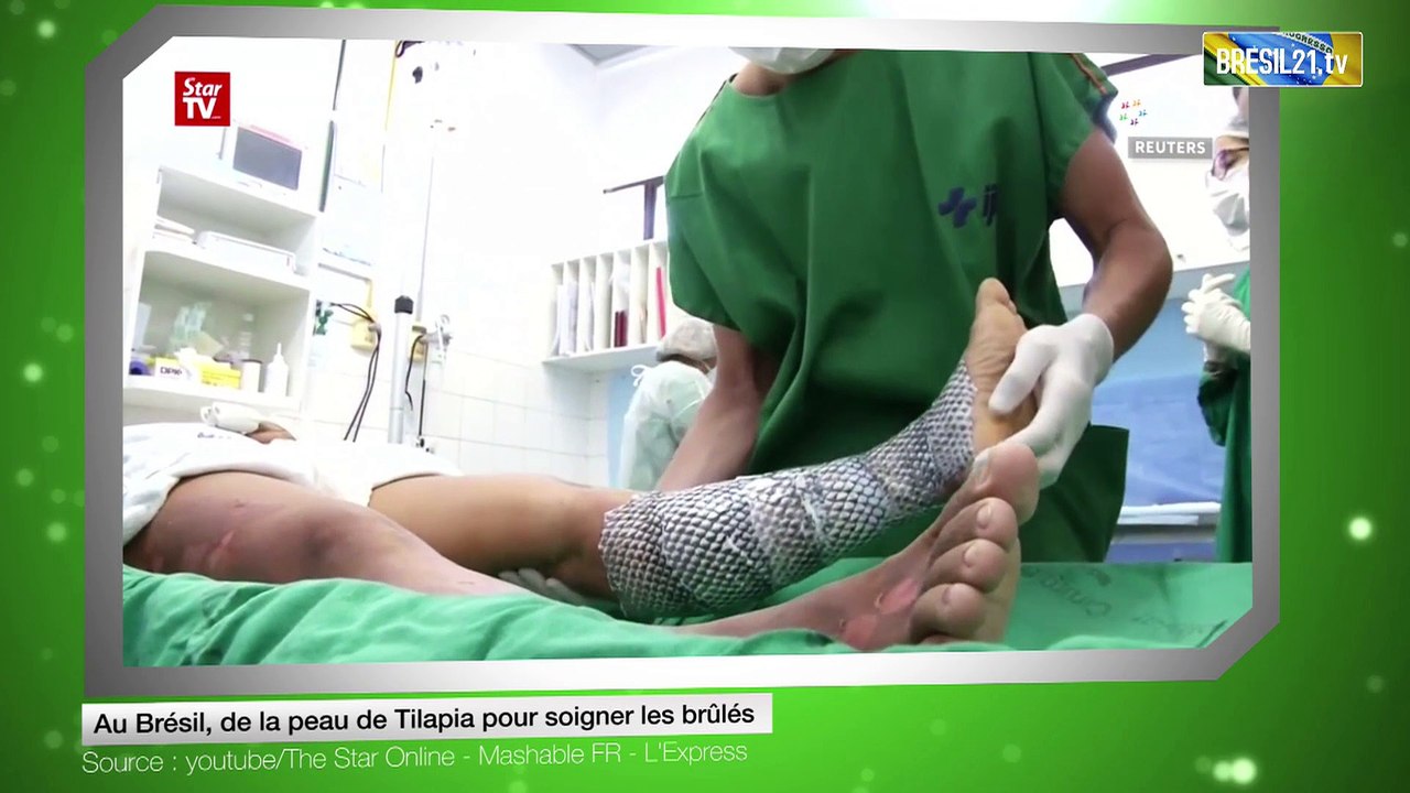 Au Brésil, de la peau de Tilapia pour soigner les brûlés