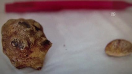 Mesanesinden 300 Gram Taş Çıktı