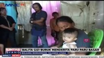 Balita Gizi Buruk Menderita Paru Paru Basah