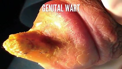 How to prevent genital warts
