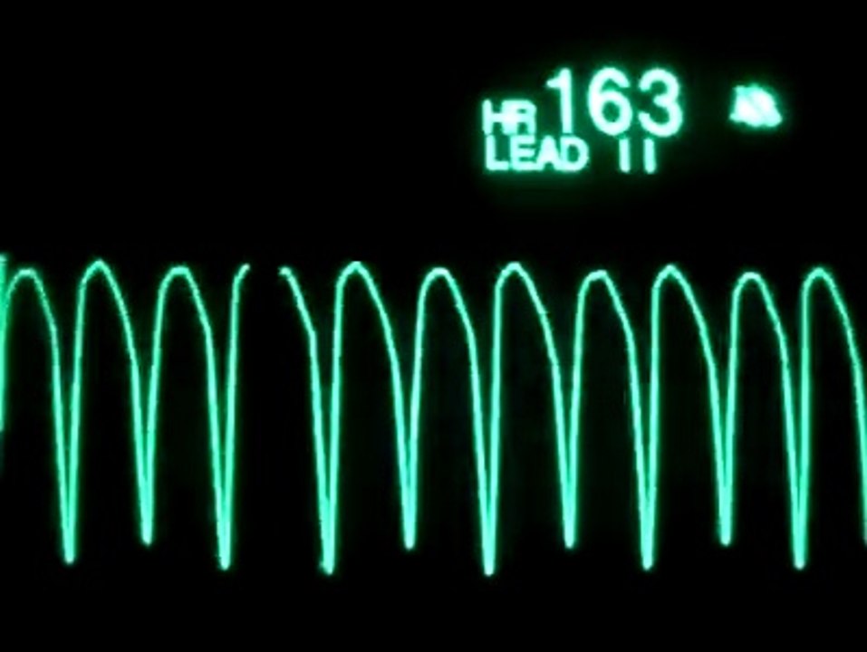 Paro Cardíaco visto desde un Electrocardiograma