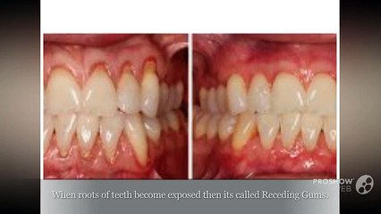 Healing Treatment For Receding Gums