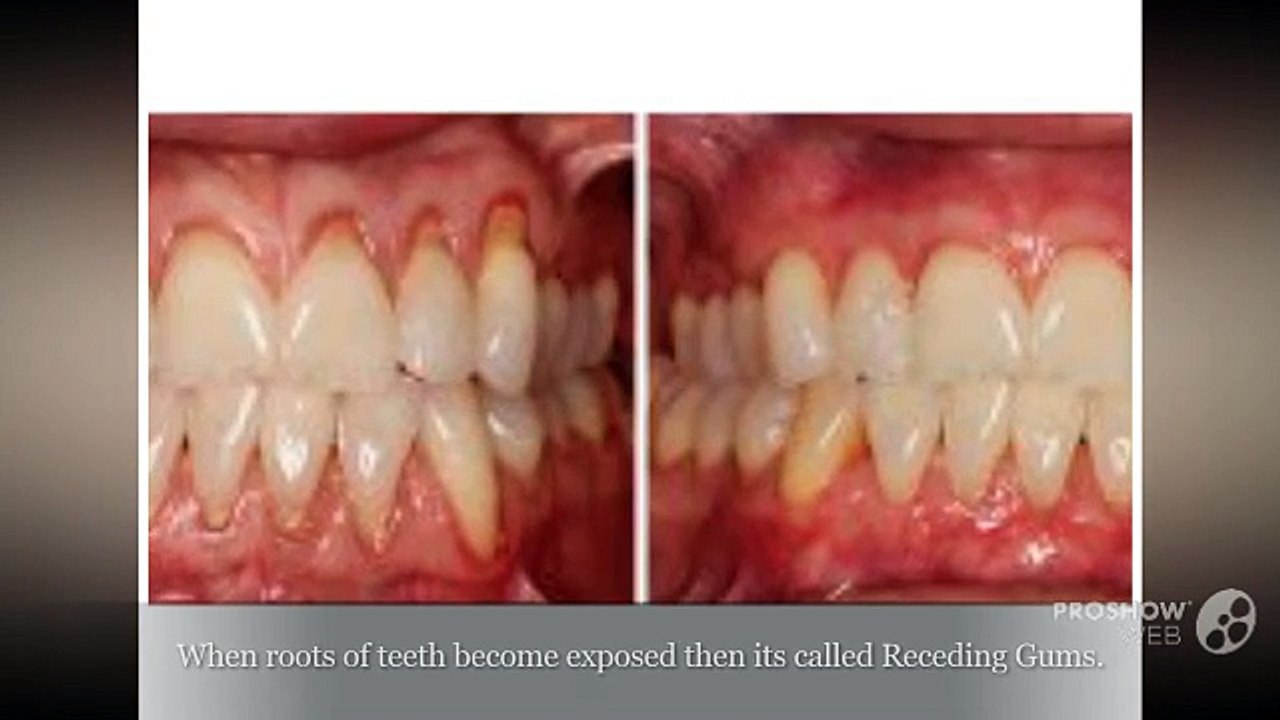 Healing Treatment For Receding Gums