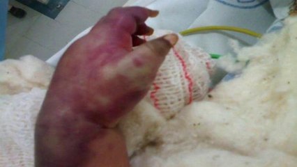 Enfermeira erra na hora de dar medicação e bebê vai perder parte dos dedos