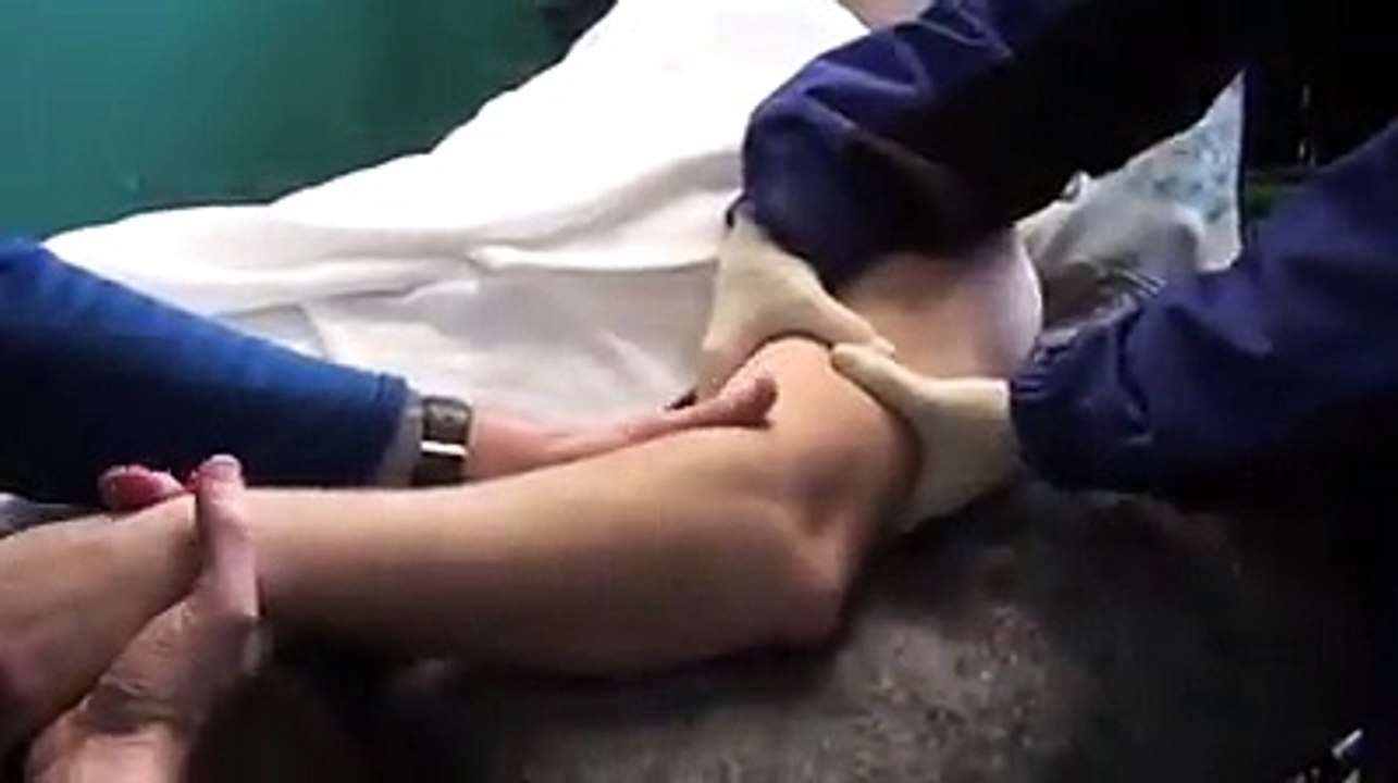 TÉCNICA DE REDUCCIÓN DE CODO