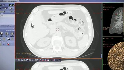Lung VCAR  Ct scanner