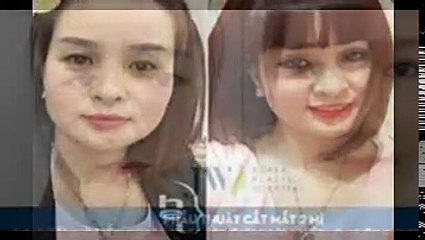 Nhấn mí Hàn Quốc đem lại cho bạn đôi mắt thu hút ánh nhìn