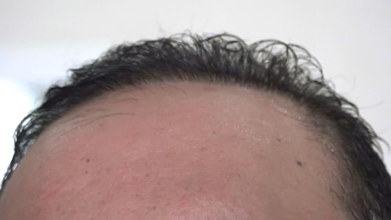 Incrementan trasplantes de cabello