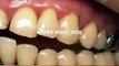 How to Periodontal Disease and Receding Gums Treatment