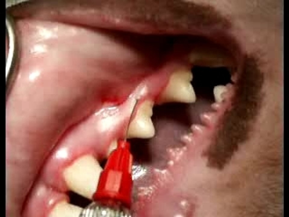 Intragingivale 1