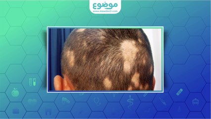 ما هي الثعلبة؟