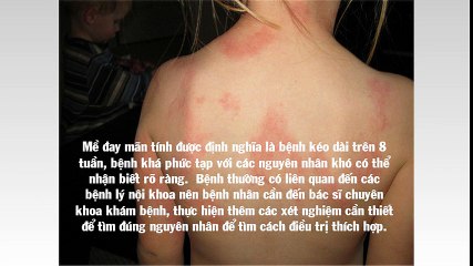 Bệnh nổi mề đay và cách chữa trị