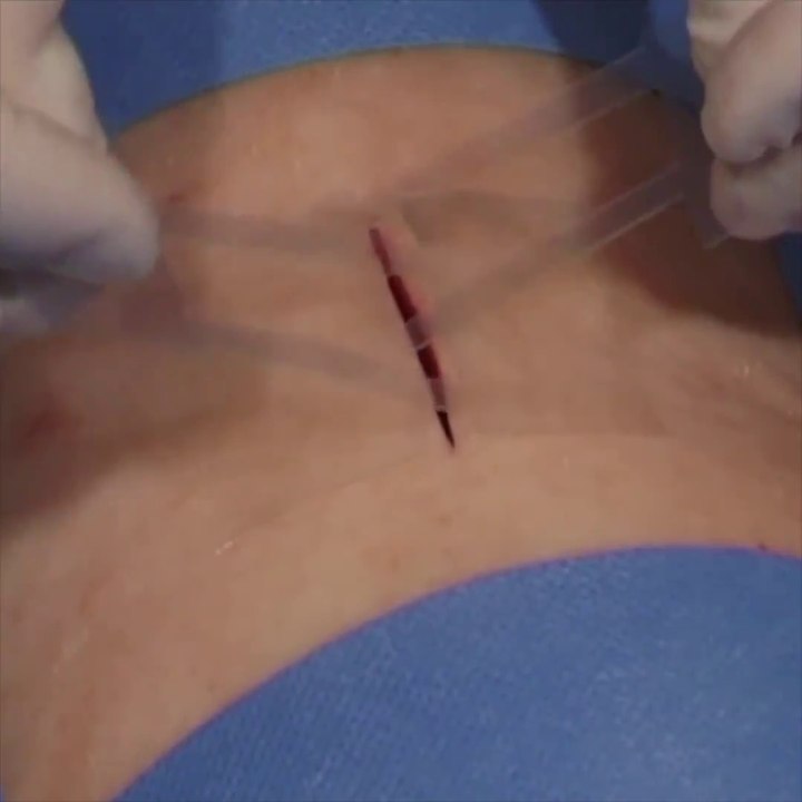 Fini les points de suture avec ce pansement révolutionnaire - Vidéo  Dailymotion