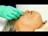 Eye Swelling - Acupuncture Facial Rejuvenation
