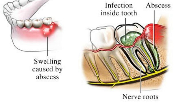 Root Canal Treatment For Infected Tooth