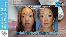 5 MIN INTRO ON FILLER INJECTIONS IN THE LIPS, NASOLABIAL FOLDS, CHEEKS, UPPER LOWER EYELIDS, & FACE