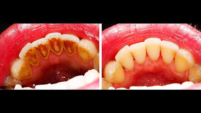 Affordable Dental Crowns Atlanta GA