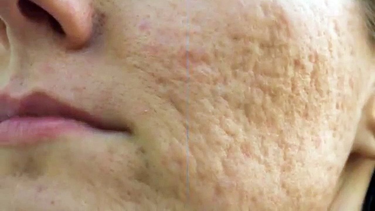 Laser Therapy for Damaged Skin
