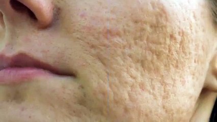 Laser Therapy for Damaged Skin