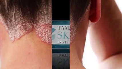 Effective Psoriasis Treatment Plan