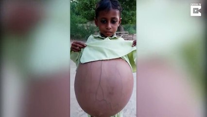 Ce jeune Pakistanais de 9 ans avec le ventre hyper gonflé attend une opération pour lui sauver la vie