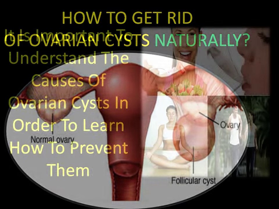 How To Get Rid Of Ovarian Cysts Naturally