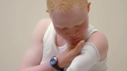 New Limbs Bring Smiles To Tanzanian Albino Children's Faces