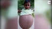 Cet enfant Pakistanais au ventre surgonflé va etre opéré car sa vie est en danger