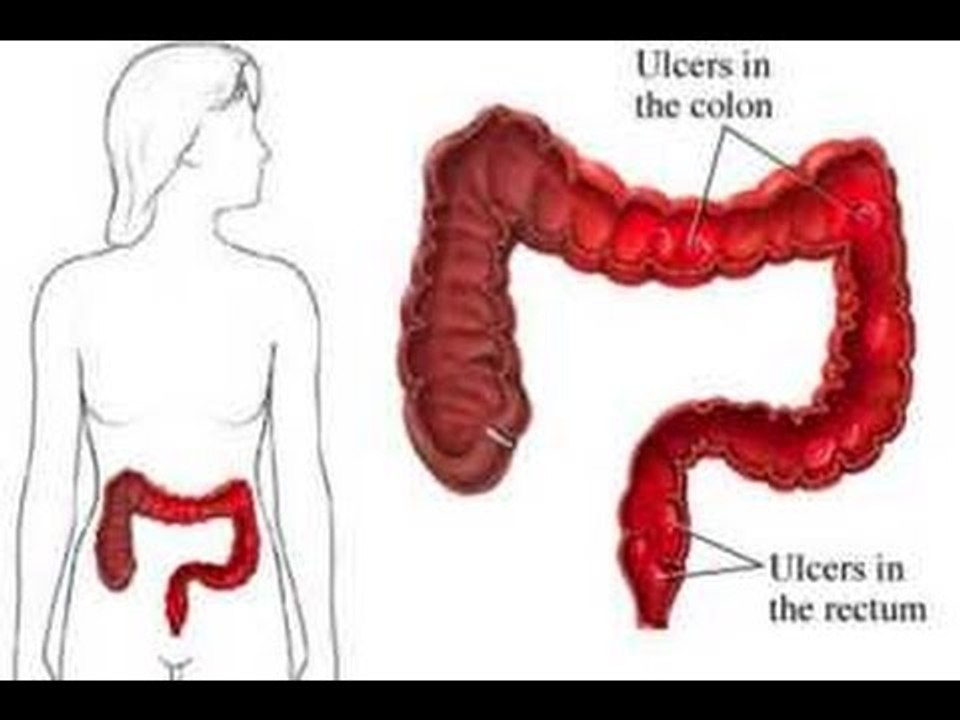 ¿Cómo eliminar la colitis? / Remedios para la colitis