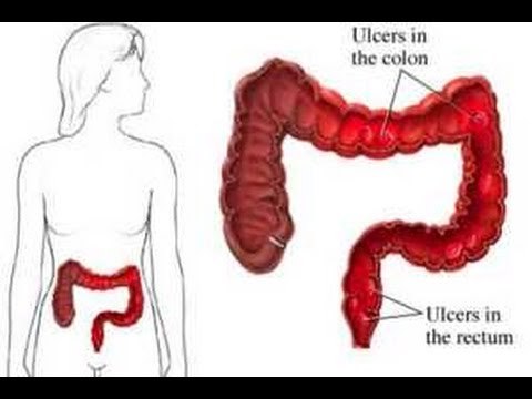 ¿Cómo eliminar la colitis? / Remedios para la colitis