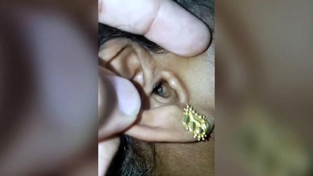 Horrific moment massive spider extracted from woman's ear - YouTube