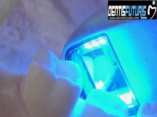 #IDS2017 : démonstration du scanner intra-oral LAVA True Definition